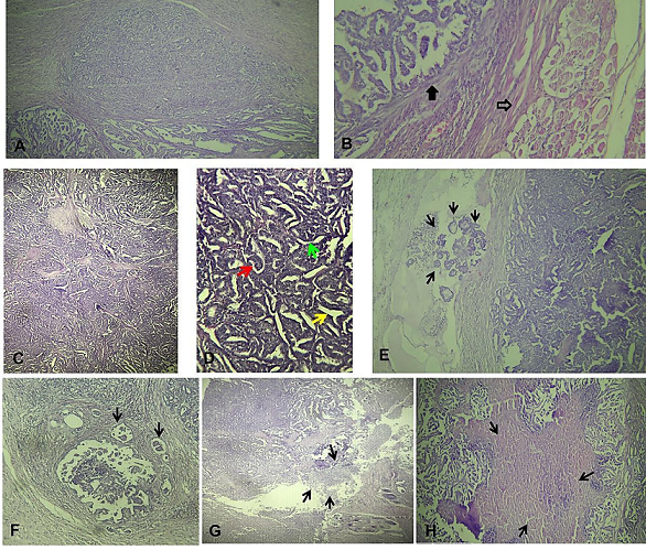 Figure 3. Microscopic aspect of the tumor using hematoxylin and eosin (H&E). A. Tumor with various architecture (X40), B. Carcinoma infiltration (black arrow) and the sampled healthy striated muscle (empty arrow, X100), C & D. Papillary (red arrow), trabecular (green arrow) and tubular (yellow arrow) architecture of tumor (high magnification), E & F. Lymphovascular tumor emboli (arrows, X200) G. Fibrinoleukocyte exudate (arrows), H. Tumor necrosis (arrows, X40).