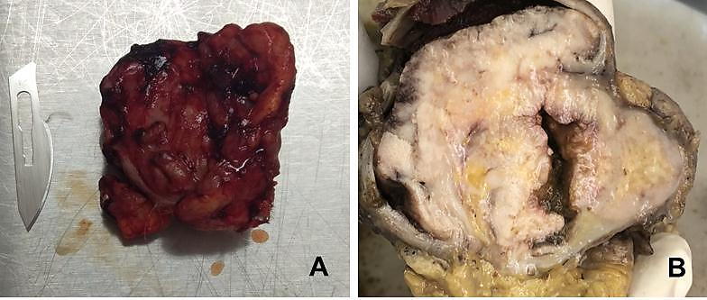 Figure 2. Gross appearance of the excised mass. A. Operatory piece, B. Cross-section of specimen.